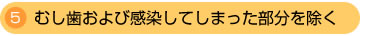 むし歯および感染してしまった部分を除く