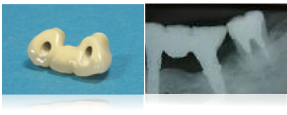 �C���v�����g�u���b�W