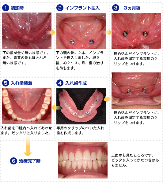 �C���v�����g�`�����Â̗���(�t���[�}�j