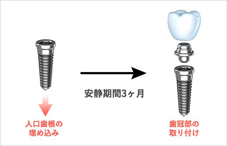 現在のインプラント治療の流れ