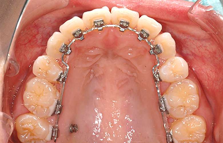 矯正の治療方法 ─舌側矯正─